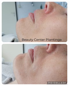 Resultaat na een kuur van 3x collageendraadlift behandeling. Meer volume en minder diepe lijnen.